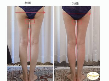 トレゾール(tresor)/★痩身★赤坂痩身エステ