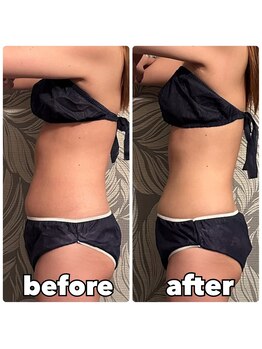 オハナ(OHANA)/フローズンリフトプロ【お腹】