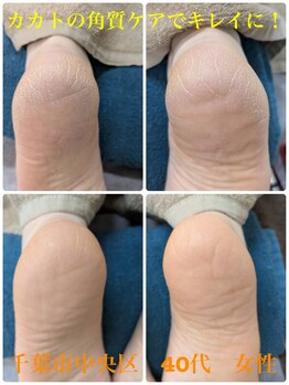 巻き爪じゅん 千葉駅前店/カカトの角質ケアで足もキレイに
