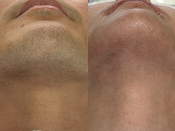 フェリス(FELIZ)/朝の身支度が楽になるヒゲ脱毛