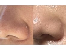 リム ビューティー(RYM BEAUTY)/ニキビケア