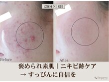 レガロビューティクリエイションズ桜川店/褒められ素肌│ニキビケア