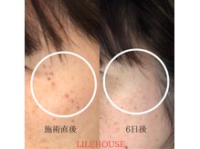リレハウス(LileHouse)の雰囲気（大人気のシミケア）