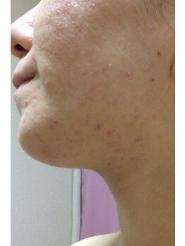 スキンケアスタジオ アコ 新宿店(Aco)/GP5Dほほポツポツ肌ケア5日後
