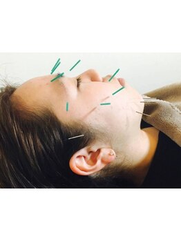 鍼灸施術を受けたい