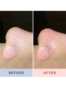 ソリス ビューティー(SOLIS BEAUTY)/毛穴洗浄