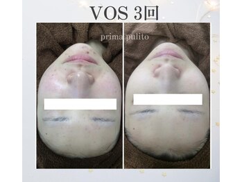 プリマプリート 各務原店/ニキビにお悩みの方