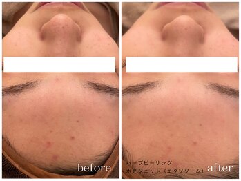 メゾンリュバン 梅田店(Maison Ruban)/ハーブピーリング・水光ジェット