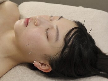 ラビィ(lovie)/美容鍼