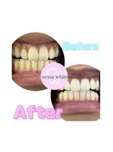 エクシアホワイトニング エミフルMASAKI店/ビフォーアフター