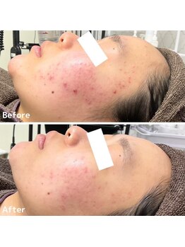 ニキビケア研究所 横浜店/毛穴吸引・水素・炭酸パックなど