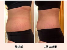 クリニカルエステ/イーズ パークプレイス大分店の雰囲気（産後なかなか落ちないお腹まわりには【脂肪分解剤】がおすすめ！）