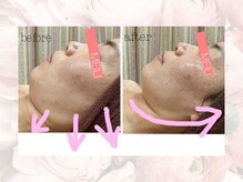 神門整体院 甲東園/REVIハーブピーリングB→A