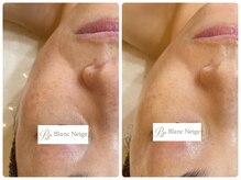 ブラン ネージュ(Blanc Neige)/マーメイドセルトリートメント