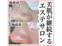 エメ(Aimer)/最新毛穴ケア