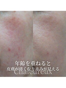 サロン ド ボーテ シャルル(Chaleureux)/年齢肌の肌改善