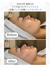 シーフェイス 横浜店(SEE FACE)/ラジオ波小顔コルギ+炭酸パック