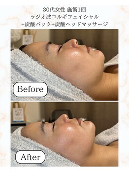 シーフェイス 横浜店(SEE FACE)/ラジオ波小顔コルギ+炭酸パック