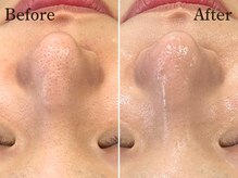 頑固な黒ずみもしっかりケア