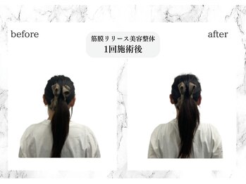 トキ(TOKI)/筋膜リリース美容整体　施術直後