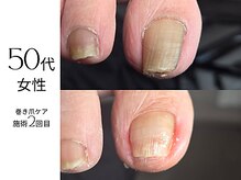 フットケア クラッシー(footcare classy)/右と左で経過が変わる？！