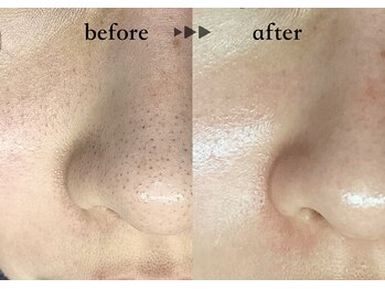 ソーヴ(SOLVE)の写真/毛穴悩み、実は『毛』かも！黒ずみ毛穴、開き毛穴、たるみ毛穴、タイプ別に毛穴ケア♪