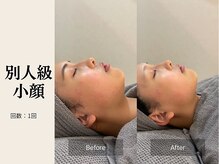 サロン ルイス アディクト(salon Lewis Addict)/小顔リフト