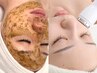 【ニキビ・肌荒れケア】剥けないハーブピーリング＋贅沢水分補給＆鎮静マスク