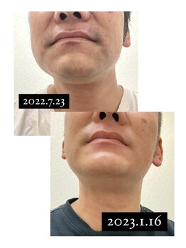 リル(Lil)/ヒゲ脱毛半年の成果☆