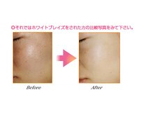 オトナの駆け込みサロン レクラ(L'eclat)の雰囲気（ウル艶水光肌人気の芸能人ピール◎施術症例写真はInstagramより）