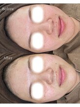 ベリスユイット(BELLIS HUIT)/【剥離なしハーブピーリング】