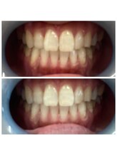 プティパ(Petit Pas)/セルフホワイトニング