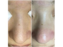 日本一の毛穴技術で毛穴の鼻・眉間・顎・額等の黒ずみとサヨナラ