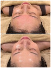 ユララ(YURARA)/美容鍼で肌質改善しませんか？