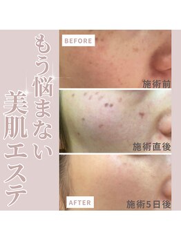 エステティックサロン ラ ベルタ(Esthetic Salon La Belta)/気になる色素に