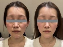 クレファ(CREFA)の雰囲気（即実感×持続力 たった1回で小顔実感！ほうれい線、シワにも◎）