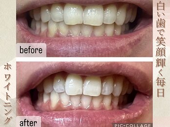 ラナ(LaNa)/白い歯で輝く笑顔を