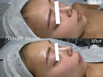 ナチュールムーン(Nature moon.)/ハーブピーリング