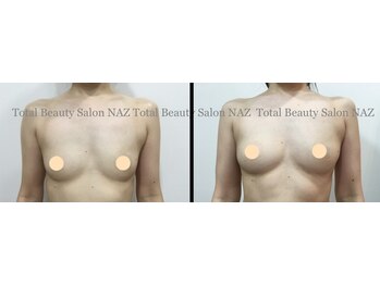 トータルビューティーサロン ナーズ(NAZ)/光バストアップ！