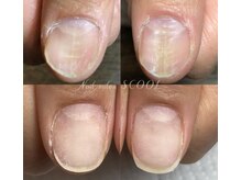 スクール(SCOOL)/トラブル爪対応店【隠さず改善】