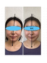 パルフェ(THE Parfait)/美容整骨【小顔矯正】