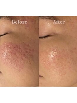 毛穴ケアをしたい