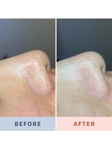 ソリス ビューティー(SOLIS BEAUTY)/毛穴洗浄