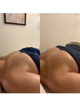 ミリミリ(mili mili)/before→after