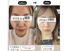 FACE【美フォト】×エレポレ大人気施術！とにかくハリが出ます