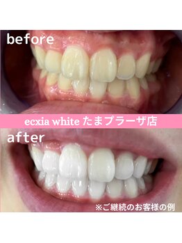 エクシアホワイトニング たまプラーザ店/ビフォーアフター
