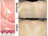 【気になる背中ニキビ・肩周りの毛】匠道ワックス★背中全体脱毛　初回9240円