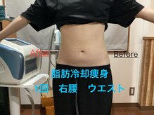 セルリアンブルー(Cerulean Blue)/脂肪冷却痩身の結果