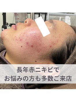 エステ ニキビケア研究所 川崎店/長年赤ニキビでお悩みの方へ!