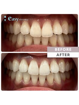 イージーホワイトニング 五反田店(easy whitening)/セルフホワイトニング症例写真